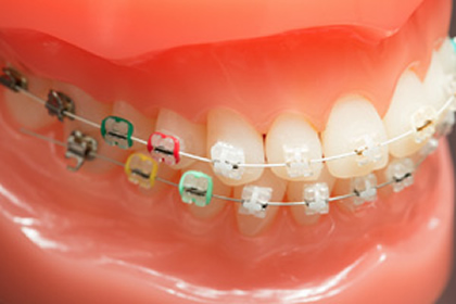 矯正治療中の歯イメージ
