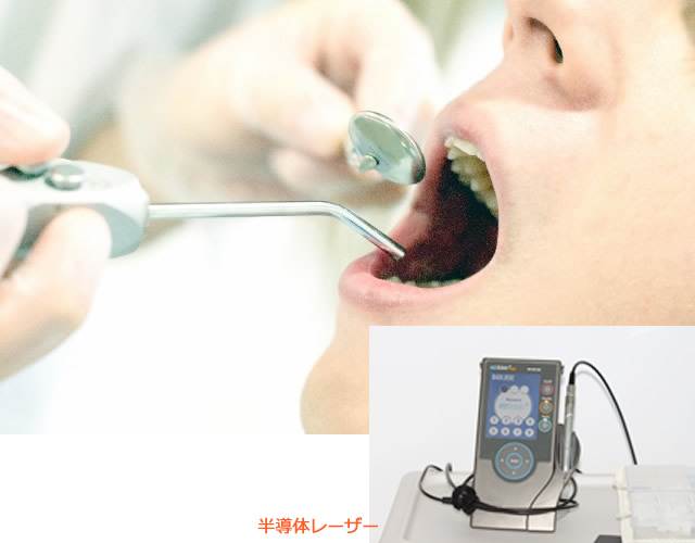 口内炎の治療